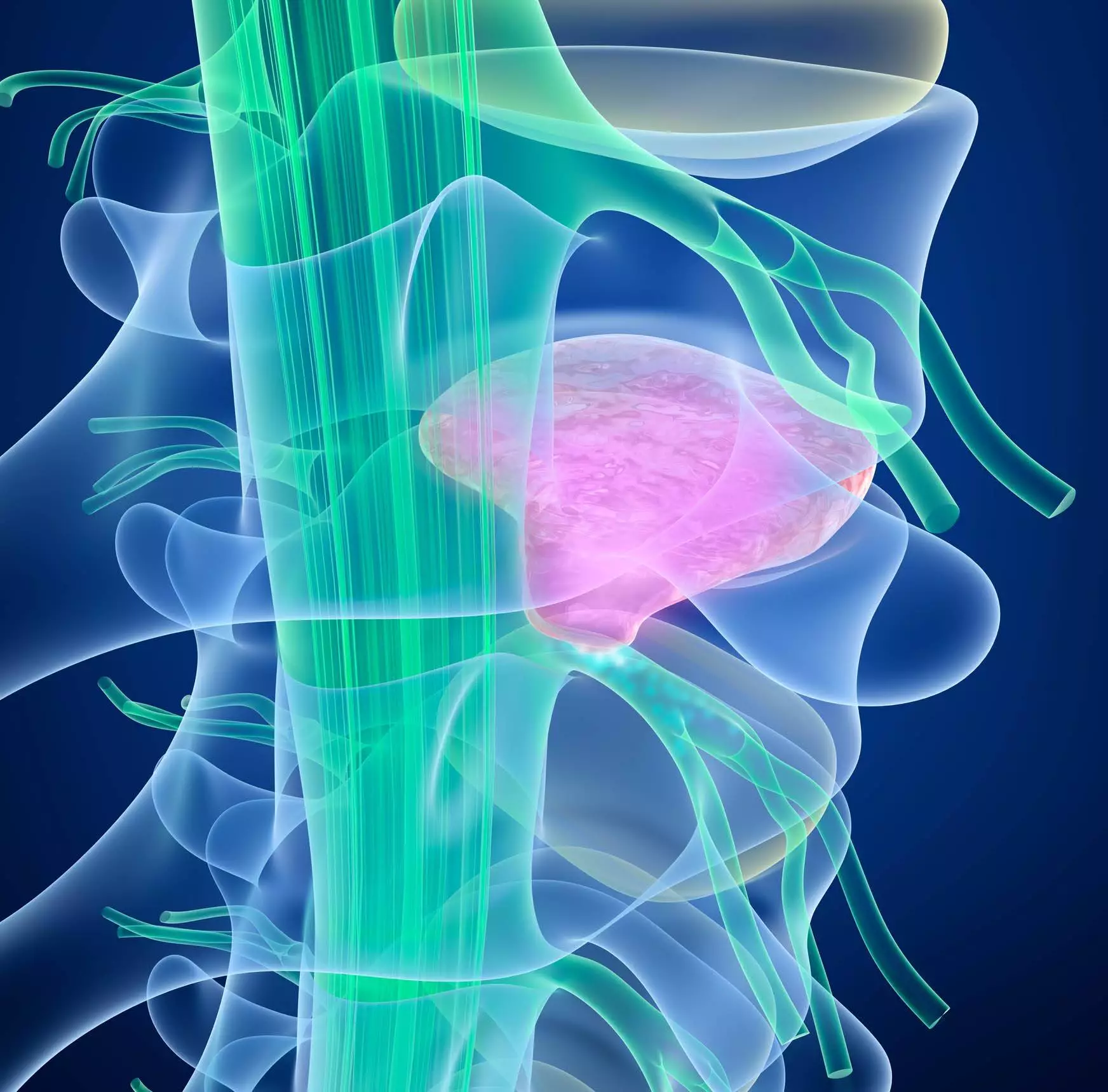 Spinal cord under pressure of bulging disc, 3D illustration