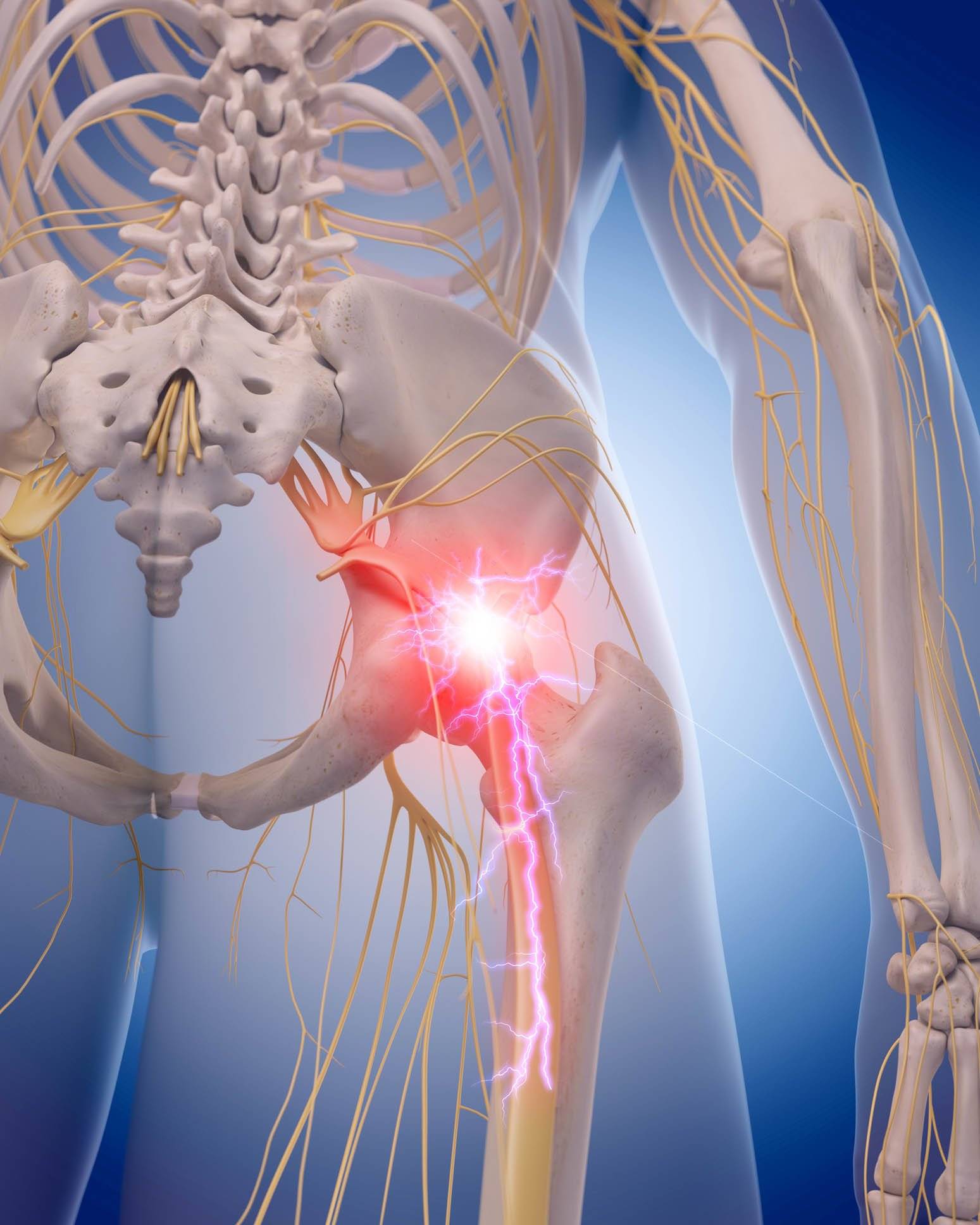 Spinal Stenosis is a common cause of low back pain and sciatica - Capitol  Pain Institute