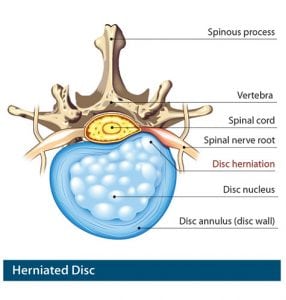 herniated disc treatment - neck & back pain treatment salt lake city - chiropractor murray