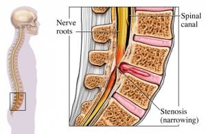 Spinal Stenosis Treatment | Back Pain Relief Murray, UT