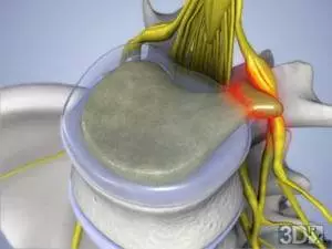 herniatedDisc-300