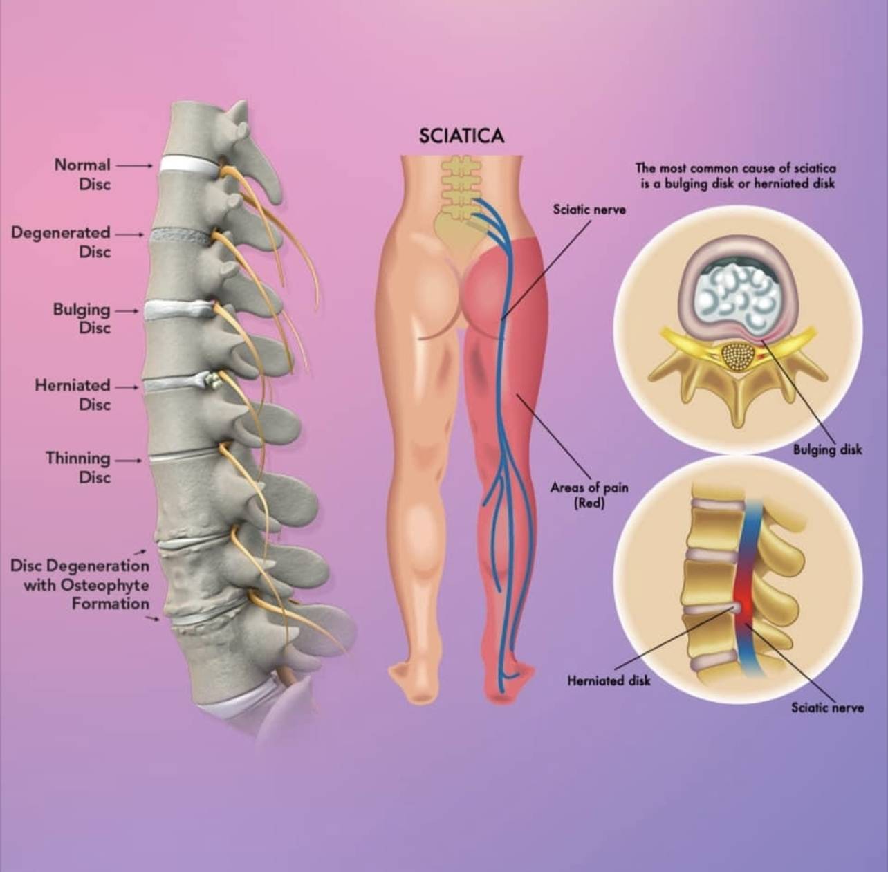 What's Sciatica?  Advanced Spine and Disc