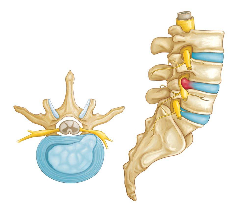 Herniated Disc Cervical/ACDF - Slipped Disc in the Neck - Little Rock, AR &  North Little Rock, AR: Martin Orthopedics